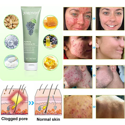 Cabernet Sauvignon Extract Purifying Exfoliating Gel🍇-For Acanthosis Nigricans, Exfoliation, Dark Spots, Skin Tags, and Eczema