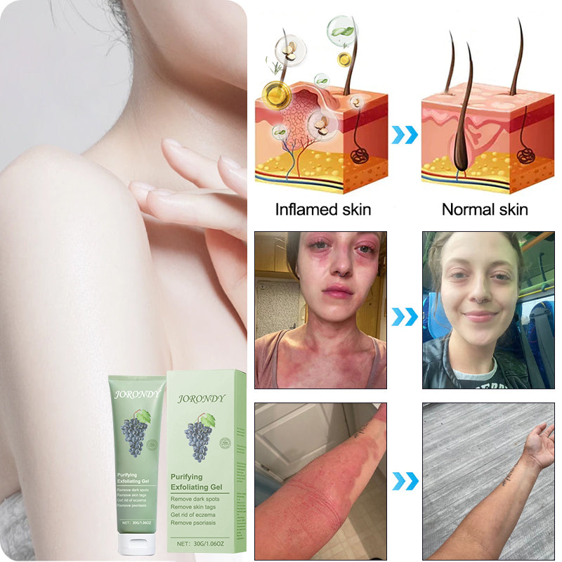 Cabernet Sauvignon Extract Purifying Exfoliating Gel🍇-For Acanthosis Nigricans, Exfoliation, Dark Spots, Skin Tags, and Eczema